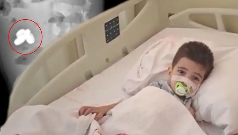 Pil ve Mıknatıs Yutan Çocuğun Ani Durumu Doktorları Şaşırttı